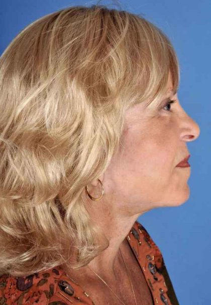 Facelift Before & After Patient #969
