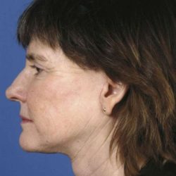 Facelift Before & After Patient #963