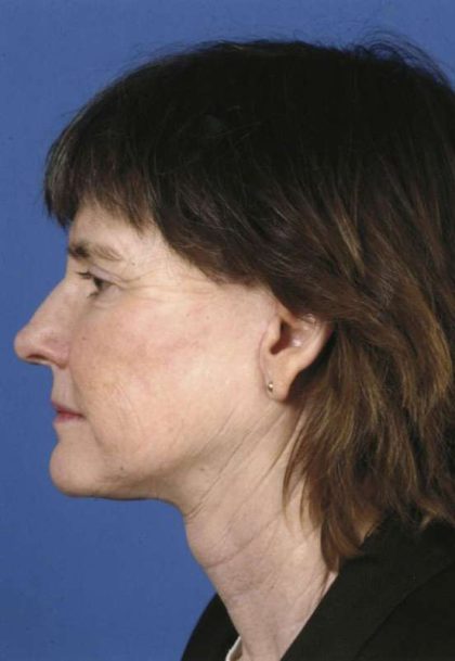 Facelift Before & After Patient #963