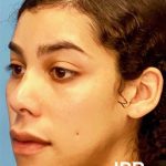 Facial Feminization Before & After Patient #924