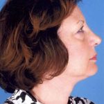 Facelift Before & After Patient #957