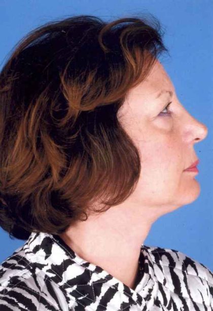 Facelift Before & After Patient #957