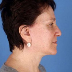 Facelift Before & After Patient #951