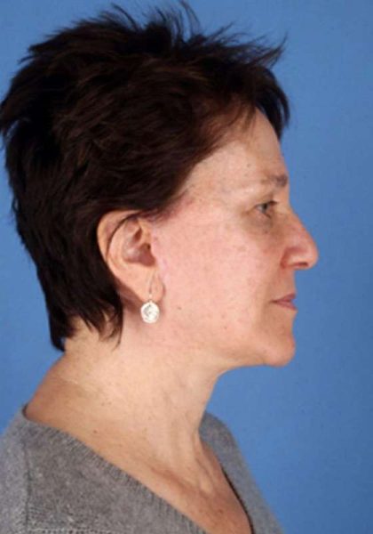 Facelift Before & After Patient #951