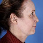 Facelift Before & After Patient #945