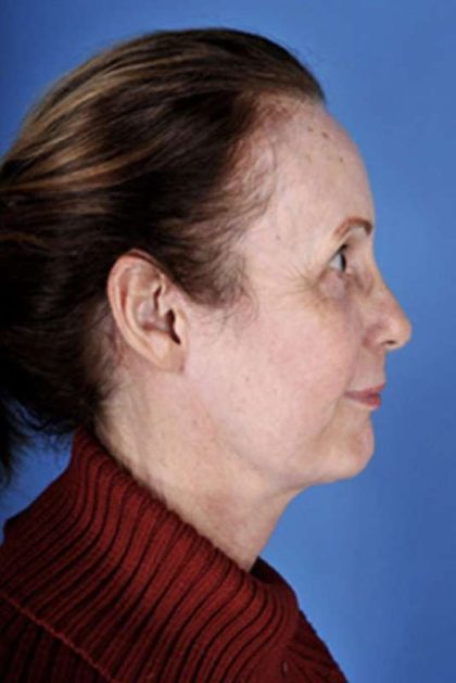 Facelift Before & After Patient #945