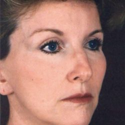 Facelift Before & After Patient #939