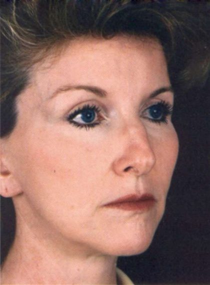 Facelift Before & After Patient #939