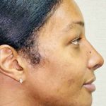Facial Feminization Before & After Patient #912