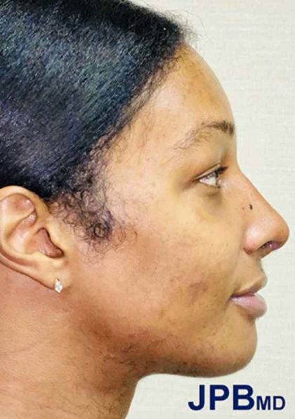 Facial Feminization Before & After Patient #912