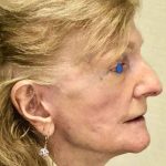 Facelift Before & After Patient #930