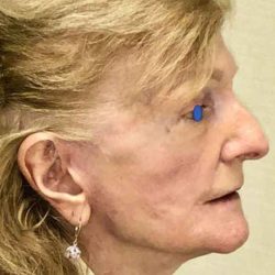 Facelift Before & After Patient #930