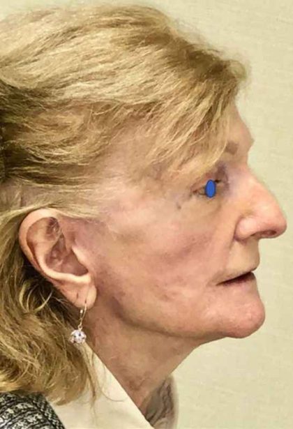 Facelift Before & After Patient #930