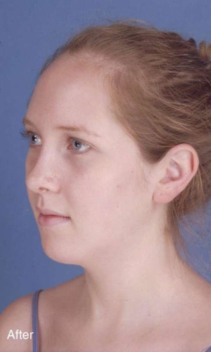 Rhinoplasty Before & After Patient #1092