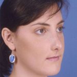 Rhinoplasty Before & After Patient #1083