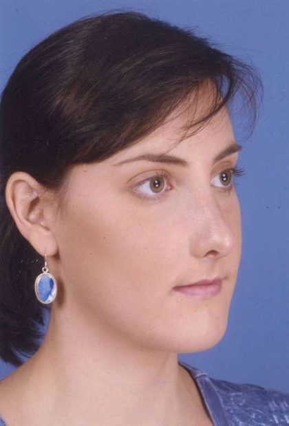 Rhinoplasty Before & After Patient #1083