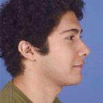 Rhinoplasty Before & After Patient #1071
