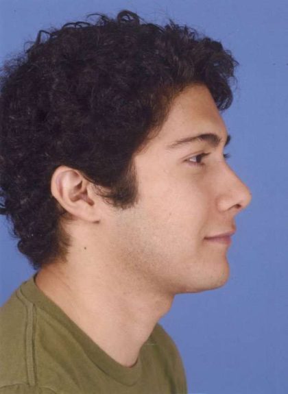 Rhinoplasty Before & After Patient #1071