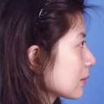 Rhinoplasty Before & After Patient #1065
