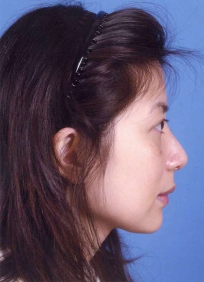 Rhinoplasty Before & After Patient #1065