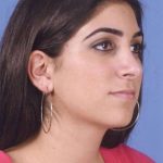 Rhinoplasty Before & After Patient #1059