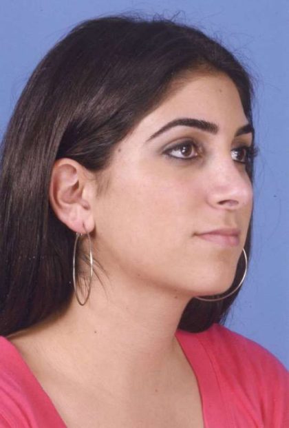 Rhinoplasty Before & After Patient #1059