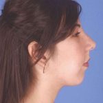 Rhinoplasty Before & After Patient #1044