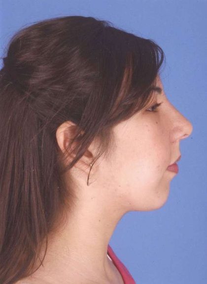 Rhinoplasty Before & After Patient #1044