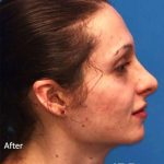 Rhinoplasty Before & After Patient #1038