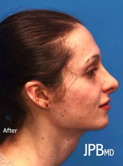 Rhinoplasty Before & After Patient #1038