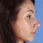 Rhinoplasty Before & After Patient #1032