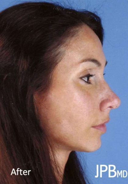 Rhinoplasty Before & After Patient #1032