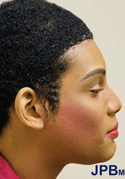 Facial Feminization Before & After Patient #906