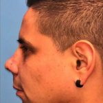 Rhinoplasty Before & After Patient #1005
