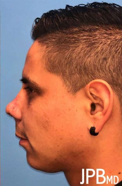 Rhinoplasty Before & After Patient #1005