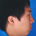 Rhinoplasty Before & After Patient #1023