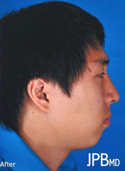 Rhinoplasty Before & After Patient #1023