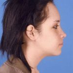 Jaw Surgery Before & After Patient #1161