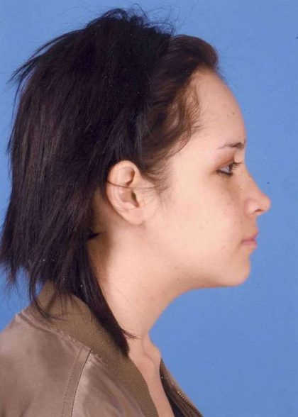 Jaw Surgery Before & After Patient #1161