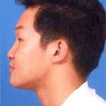 Jaw Surgery Before & After Patient #1155