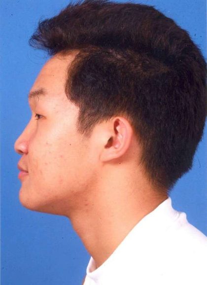 Jaw Surgery Before & After Patient #1155