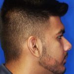 Jaw Surgery Before & After Patient #1149