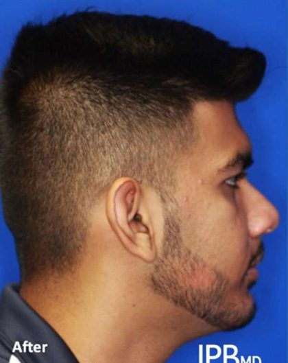 Jaw Surgery Before & After Patient #1149