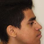 Jaw Surgery Before & After Patient #1137