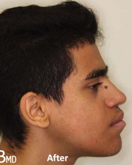 Jaw Surgery Before & After Patient #1137