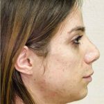Facial Feminization Before & After Patient #900