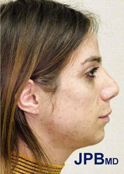 Facial Feminization Before & After Patient #900