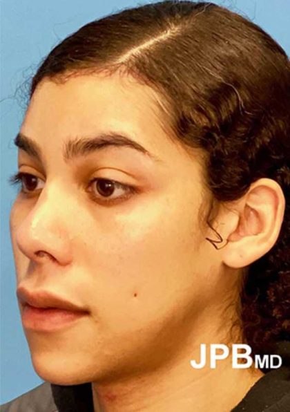 Facial Feminization Before & After Patient #924