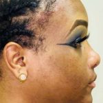 Facial Feminization Before & After Patient #894