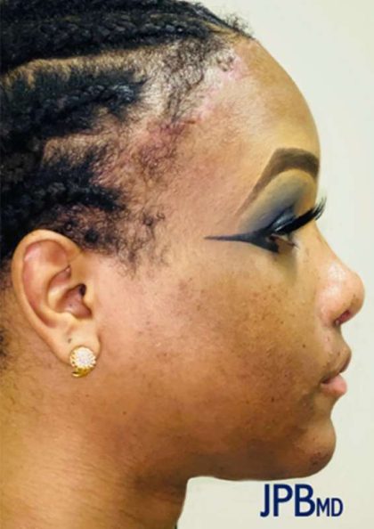 Facial Feminization Before & After Patient #894